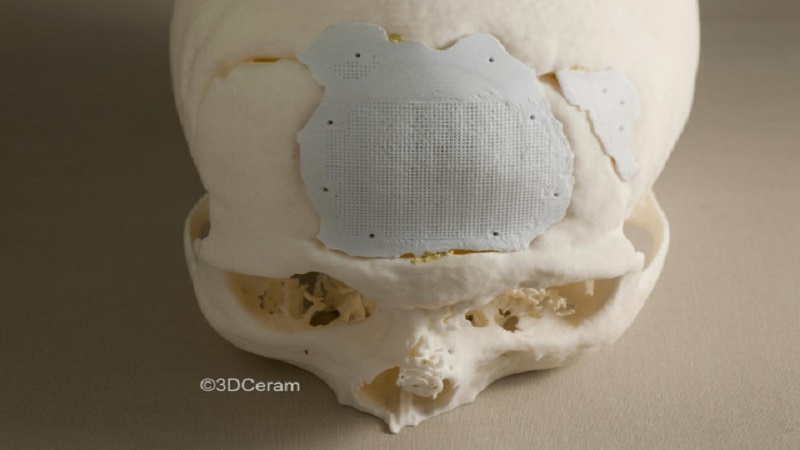 一张图和四类案例了解陶瓷3D打印技术的医疗应用