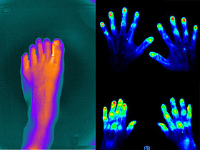 新型足部相机可帮助早期风湿病的诊疗